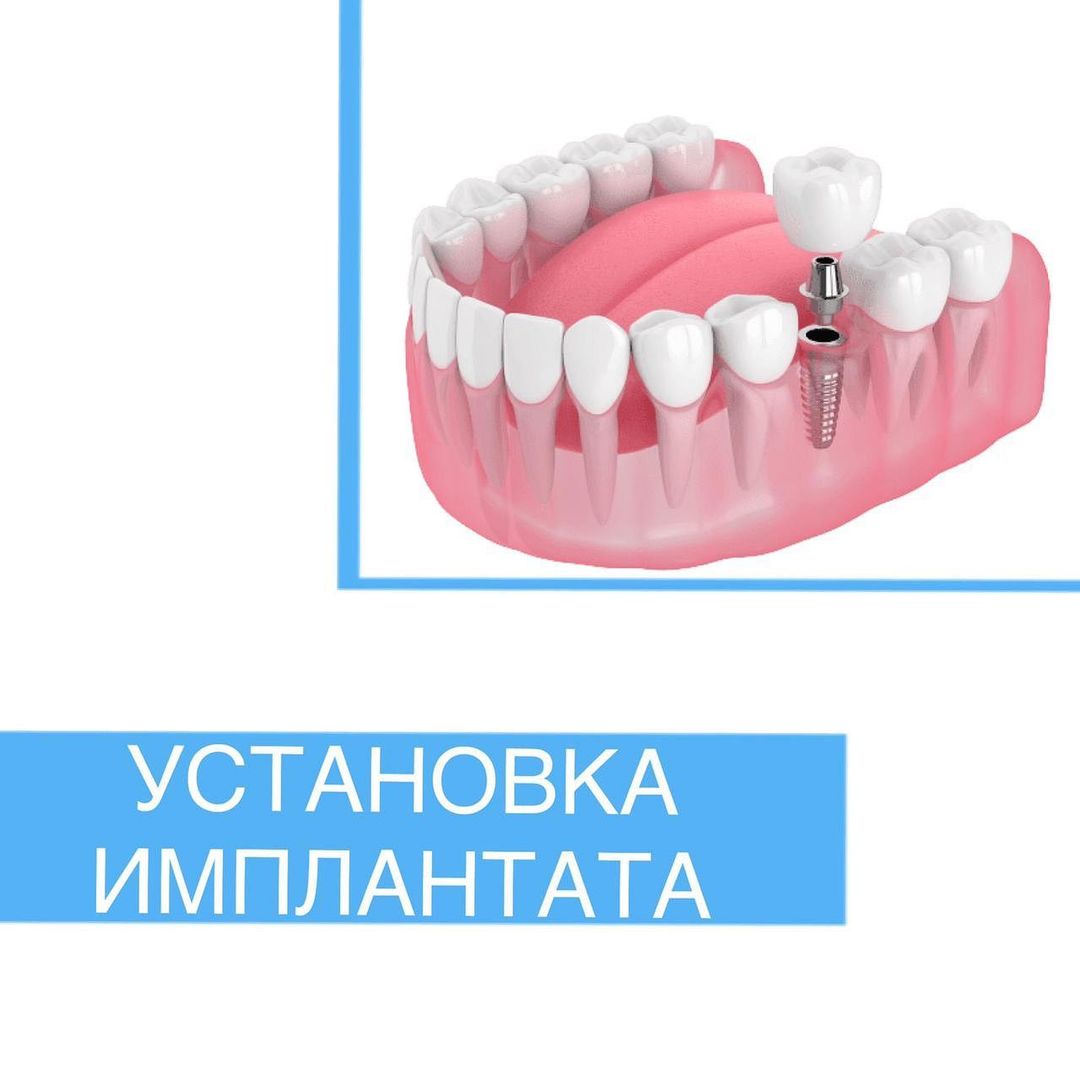 Удалил зуб, когда можно ставить имплант?
