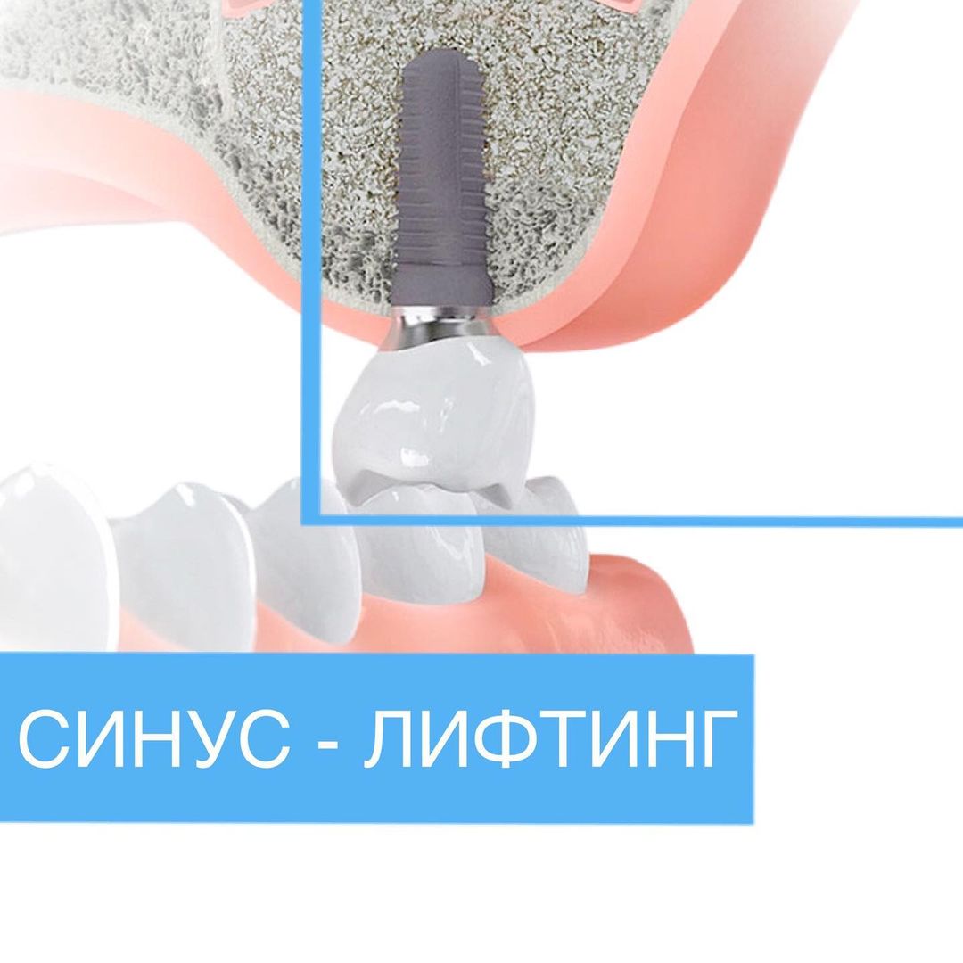 Что такое синус-лифтинг?